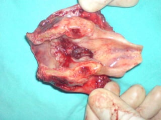 LaringectomiasupracricoideaT2, ó T3 siempre que solo haya invasión al espacio preepiglóticoMovilidad cordal alterada o no.FEV1 >50%Sin enfermedad en base de lengua o muy cercanaal hioides.Sin involucro del apexdel seno piriformeExtensión subglóticano mayor de 10 mm.Preservar un aritenoide.