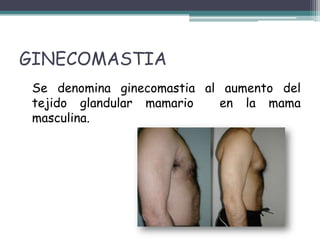 GINECOMASTIA
 Se denomina ginecomastia al aumento del
 tejido glandular mamario   en la mama
 masculina.
 