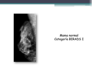 Mama normal
Categoría BIRADS I
 