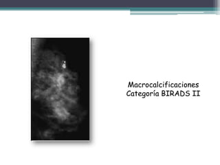 Macrocalcificaciones
Categoría BIRADS II
 