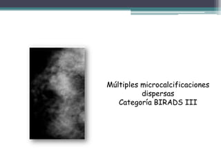 Múltiples microcalcificaciones
          dispersas
   Categoría BIRADS III
 