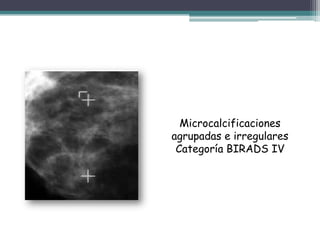 Microcalcificaciones
agrupadas e irregulares
 Categoría BIRADS IV
 