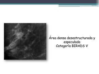 Área densa desestructurada y
         especulada
    Categoría BIRADS V
 