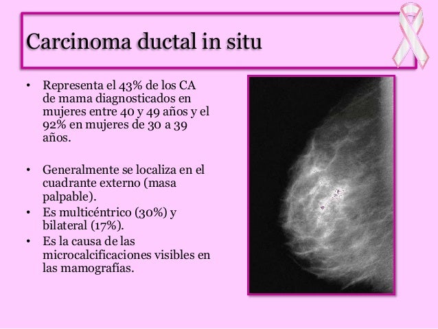 Cáncer de Mama
