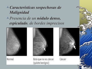 Características sospechosas de
Malignidad
Presencia de un nódulo denso,
espiculado, de bordes imprecisos
 