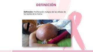Definición: Proliferación maligna de las células de
los tejidos de la mama.
DEFINICIÓN
 