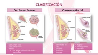 CLASIFICACIÓN
Carcinoma Lobular Carcinoma Ductal
• Intraductal (in
situ)
• Invasivo
• Mucinoso
• Medular
• Papilar
• Adenoquístico
• Secretor
• Lobular (in situ)
• Lobular invasico
• Pezón
• Enf. Paget (Sin/con carcinoma
intraductal
 