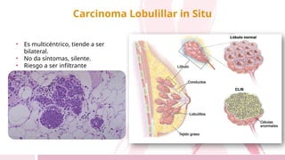 Carcinoma Lobulillar in Situ
• Es multicéntrico, tiende a ser
bilateral.
• No da síntomas, silente.
• Riesgo a ser infiltrante
 