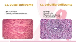 Ca. Ductal Infiltrante
• Más común 50%
• Tasa de proliferación elevada
Ca. Lobulillar Infiltrante
• Agresivo
• Multicéntrico
• Metástasis a distancia
• Bilateralidad 35 – 59%
 