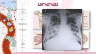 METÁSTASIS
 