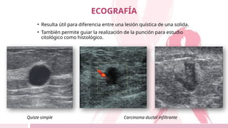 • Resulta útil para diferencia entre una lesión quística de una solida.
• También permite guiar la realización de la punción para estudio
citológico como histológico.
ECOGRAFÍA
Carcinoma ductal infiltrante
Quiste simple
 