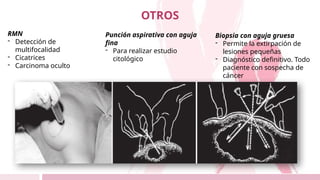 OTROS
RMN
- Detección de
multifocalidad
- Cicatrices
- Carcinoma oculto
Punción aspirativa con aguja
fina
- Para realizar estudio
citológico
Biopsia con aguja gruesa
- Permite la extirpación de
lesiones pequeñas
- Diagnóstico definitivo. Todo
paciente con sospecha de
cáncer
 