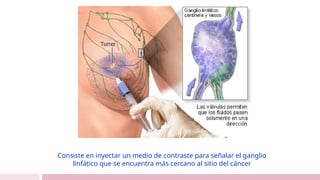 Consiste en inyectar un medio de contraste para señalar el ganglio
linfático que se encuentra más cercano al sitio del cáncer
 