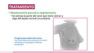 • Mastectomía parcial o segmentaria
• Se extirpa la parte del seno que tiene cáncer y
algo del tejido normal circundante
Cirugía preservadora de mama.
Las líneas de puntos encierran el tumor
extirpado y los ganglios linfáticos
extirpables
TRATAMIENTO
 