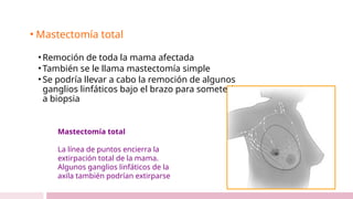 • Mastectomía total
• Remoción de toda la mama afectada
• También se le llama mastectomía simple
• Se podría llevar a cabo la remoción de algunos
ganglios linfáticos bajo el brazo para someterlos
a biopsia
Mastectomía total
La línea de puntos encierra la
extirpación total de la mama.
Algunos ganglios linfáticos de la
axila también podrían extirparse
 