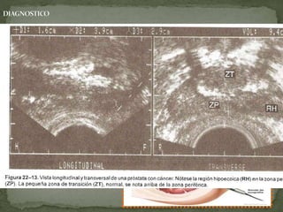 ECOGRAFIA
TRANSRECTAL
AYUDA A DIRIGIR LA AGUJA
DE BIOPSIA A ZONAS DE
LA PRÓSTATA SOSPECHOSA
AFECCION DE LA CAPSULA
PROSTÁTICA Y
VESÍCULAS SEMINALES
BIOPSISA SEXTANTE O
SEGMENTARIA
 
