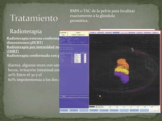 Radioterapia
RMN o TAC de la pelvis para localizar
exactamente a la glándula
prostática.
Radioterapia externa conformada en tres
dimensiones(3DCRT)
Radioterapia por intensidad modulada
(IMRT)
Radioterapia conformada con protones:
diarrea, algunas veces con sangre en las
heces, irritación intestinal.entre el 10 y el
20% Entre el 30 y el
60% impotentensia a los dos años
 