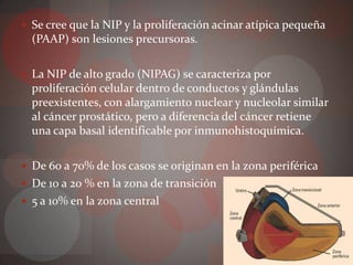  Se cree que la NIP y la proliferación acinar atípica pequeña
  (PAAP) son lesiones precursoras.

 La NIP de alto grado (NIPAG) se caracteriza por
  proliferación celular dentro de conductos y glándulas
  preexistentes, con alargamiento nuclear y nucleolar similar
  al cáncer prostático, pero a diferencia del cáncer retiene
  una capa basal identificable por inmunohistoquímica.

 De 60 a 70% de los casos se originan en la zona periférica
 De 10 a 20 % en la zona de transición
 5 a 10% en la zona central
 