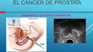 .
EL CÁNCER DE PRÓSTATA
DIAGNÓSTICO: ECOGRAFÍA TRANSRECTAL
 