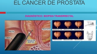 EL CÁNCER DE PRÓSTATA
DIAGNÓSTICO: BIOPSIA TRANSRRECTAL
 