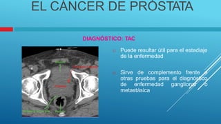 EL CÁNCER DE PRÓSTATA
DIAGNÓSTICO: TAC
 Puede resultar útil para el estadiaje
de la enfermedad
 Sirve de complemento frente a
otras pruebas para el diagnóstico
de enfermedad ganglionar o
metastásica
 
