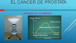 EL CÁNCER DE PRÓSTATA
DIAGNÓSTICO: FLUJOMETRÍA
 