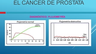 EL CÁNCER DE PRÓSTATA
DIAGNÓSTICO: FLUJOMETRÍA
 