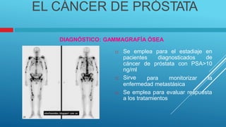 EL CÁNCER DE PRÓSTATA
DIAGNÓSTICO: GAMMAGRAFÍA ÓSEA
 Se emplea para el estadiaje en
de
pacientes diagnosticados
cáncer
ng/ml
 Sirve
de próstata con PSA>10
para monitorizar la
enfermedad metastásica
 Se emplea para evaluar respuesta
a los tratamientos
 