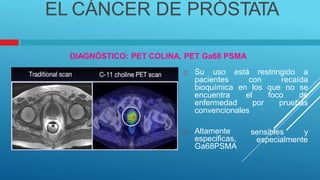 EL CÁNCER DE PRÓSTATA
DIAGNÓSTICO: PET COLINA, PET Ga68 PSMA
 Su uso está restringido a
pacientes con recaída
bioquímica en los que no se
encuentra el foco de
enfermedad por pruebas
convencionales
 Altamente
especificas,
Ga68PSMA
sensibles y
especialmente
 