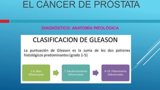 EL CÁNCER DE PRÓSTATA
DIAGNÓSTICO: ANATOMÍA PA
TOLÓGICA
 