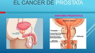 EL CÁNCER DE PRÓSTATA
ANATOMÍA PROSTÁTICA
 