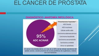 EL CÁNCER DE PRÓSTATA
DIAGNÓSTICO: ANATOMÍA PA
TOLÓGICA
 