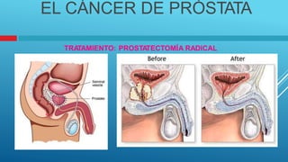 EL CÁNCER DE PRÓSTATA
TRA
TAMIENTO: PROSTA
TECTOMÍA RADICAL
 