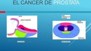 IIIV.UU,~KETRA
MU!A:ULO
'IIORJ.l
EL CÁNCER DE PRÓSTATA
I.
URH~
Ull:TR
.4 tQHA
Clll11A
l
YlSt:.USl.1111
1Al
Cllll:41ct.JS
l YIIWA!Xll.a Z'Cfl~ ~au;~
 