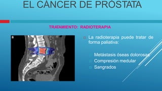 EL CÁNCER DE PRÓSTATA
TRA
TAMIENTO: RADIOTERAPIA
 La radioterapia
forma paliativa:
puede tratar de
 Metástasis óseas dolorosas
 Compresión medular
 Sangrados
 