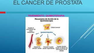 EL CÁNCER DE PRÓSTATA
TRA
TAMIENTO: QUIMIOTERAPIA
 