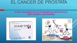 EL CÁNCER DE PRÓSTATA
OTROS TRA
TAMIENTOS EN ENFERMEDAD METASTÁSICA
OSEA ZOMETA, DENOSUMAB
 