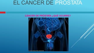 EL CÁNCER DE PRÓSTATA
CÁNCER DE PRÓSTA
TA ¿QUÉ OCURRE?
 