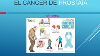 EL CÁNCER DE PRÓSTATA
SÍNTOMAS
.
 