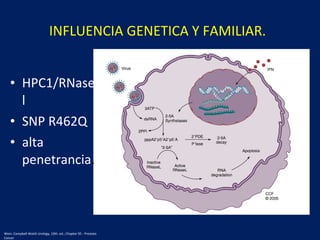 • HPC1/RNase
l
• SNP R462Q
• alta
penetrancia.
INFLUENCIA GENETICA Y FAMILIAR.
Wein: Campbell-Walsh Urology, 10th. ed.; Chapter 95 - Prostate
Cancer
 