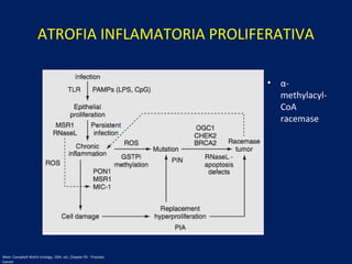 ATROFIA INFLAMATORIA PROLIFERATIVA
• α-
methylacyl-
CoA
racemase
Wein: Campbell-Walsh Urology, 10th. ed.; Chapter 95 - Prostate
Cancer
 