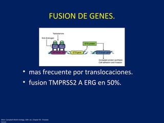 FUSION DE GENES.
• mas frecuente por translocaciones.
• fusion TMPRSS2 A ERG en 50%.
Wein: Campbell-Walsh Urology, 10th. ed.; Chapter 95 - Prostate
Cancer
 