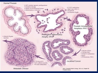 Wein: Campbell-Walsh Urology, 10th. ed.; Chapter 95 -
Prostate Cancer
 