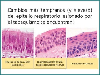 Cambios más tempranos (y «leves»)
del epitelio respiratorio lesionado por
el tabaquismo se encuentran:
Hiperplasia de las células
caliciformes
Hiperplasia de las células
basales (células de reserva) metaplasia escamosa
 
