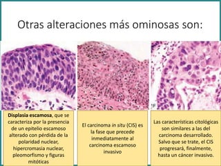 Otras alteraciones más ominosas son:
Displasia escamosa, que se
caracteriza por la presencia
de un epitelio escamoso
alterado con pérdida de la
polaridad nuclear,
hipercromasia nuclear,
pleomorfismo y figuras
mitóticas
El carcinoma in situ (CIS) es
la fase que precede
inmediatamente al
carcinoma escamoso
invasivo
Las características citológicas
son similares a las del
carcinoma desarrollado.
Salvo que se trate, el CIS
progresará, finalmente,
hasta un cáncer invasivo.
 