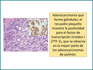 Adenocarcinoma que
forma glándulas; el
recuadro pequeño
muestra la positividad
para el factor de
transcripción tiroideo I
(TTF-1), que se observa
en la mayor parte de
los adenocarcinomas
de pulmón.
 
