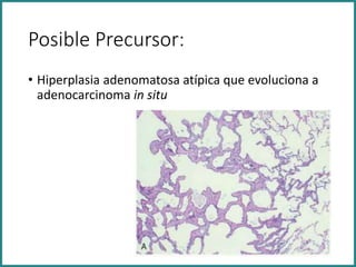 Posible Precursor:
• Hiperplasia adenomatosa atípica que evoluciona a
adenocarcinoma in situ
 