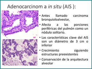 Adenocarcinom a in situ (AIS ):
• Antes llamado carcinoma
bronquioloalveolar,
• Afecta a las porciones
periféricas del pulmón como un
nódulo solitario.
• Las características clave del AIS
son un diámetro de 3 cm o
inferior
• Crecimiento siguiendo
estructuras preexistentes
• Conservación de la arquitectura
alveolar
 