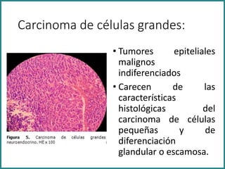 Carcinoma de células grandes:
• Tumores epiteliales
malignos
indiferenciados
• Carecen de las
características
histológicas del
carcinoma de células
pequeñas y de
diferenciación
glandular o escamosa.
 