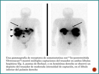 Una gammagrafía de receptores de somatostatina con111In-pentetreótida
(Octreoscan®) mostró múltiples captaciones del trazador en ambos lóbulos
hepáticos (fig. 3, puntas de flechas), y en hemitórax derecho se observó un
depósito del trazador de moderada intensidad de captación, en el lóbulo
inferior del pulmón derecho
 